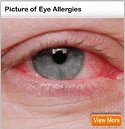 eye allergies